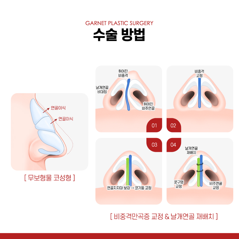 【가넷성형외과 백인수원장 성형칼럼】 휜코 무보형물 코성형 시 주의사항 관련 이미지 4