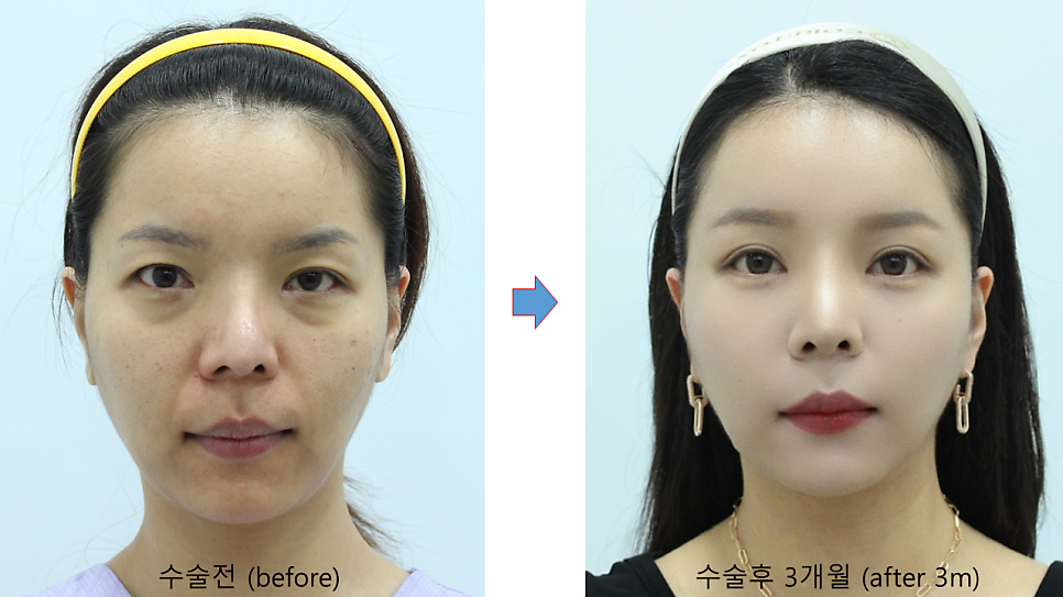 다이어트후 발생한 얼굴의 노화 관련 이미지 9
