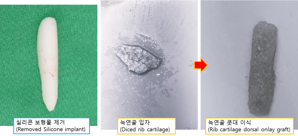 실리콘 부작용 구축코, 자가 늑연골 코재수술로 자연스럽게 복원하기 관련 이미지 3