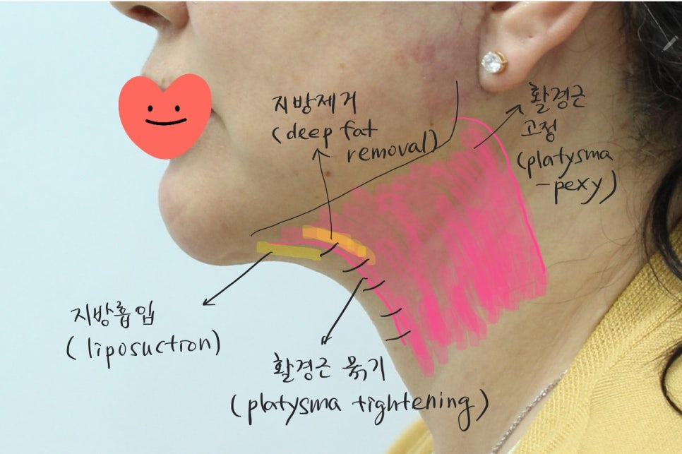 Submental Incision Neck Lift Performed Together with Facelift image 6