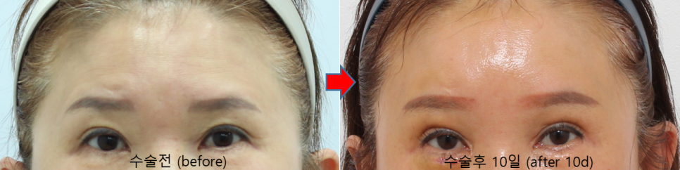 Endoscopic Forehead Lift for a Smooth Forehead image 3