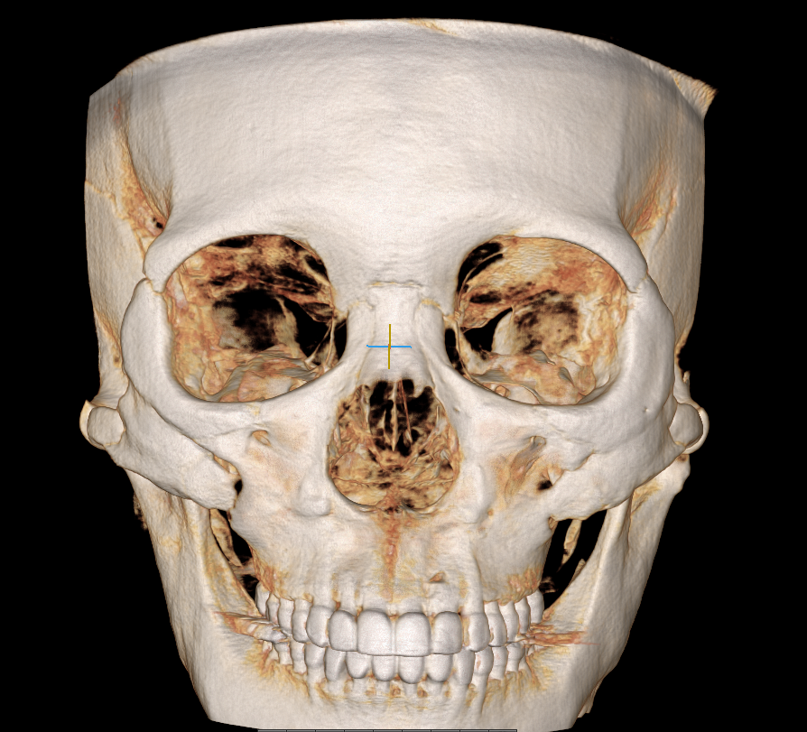 Cheek Sagging After Cheekbone Reduction Surgery? image 1
