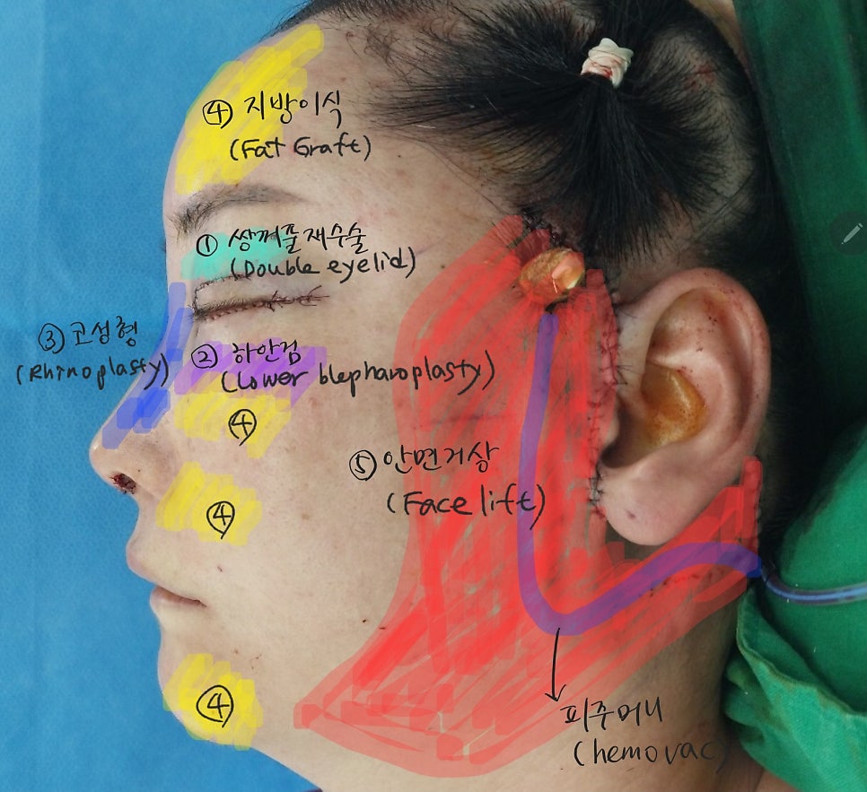 The Surgery Time and Recovery Period for Various Middle-Age Anti-Aging Surgeries image 6