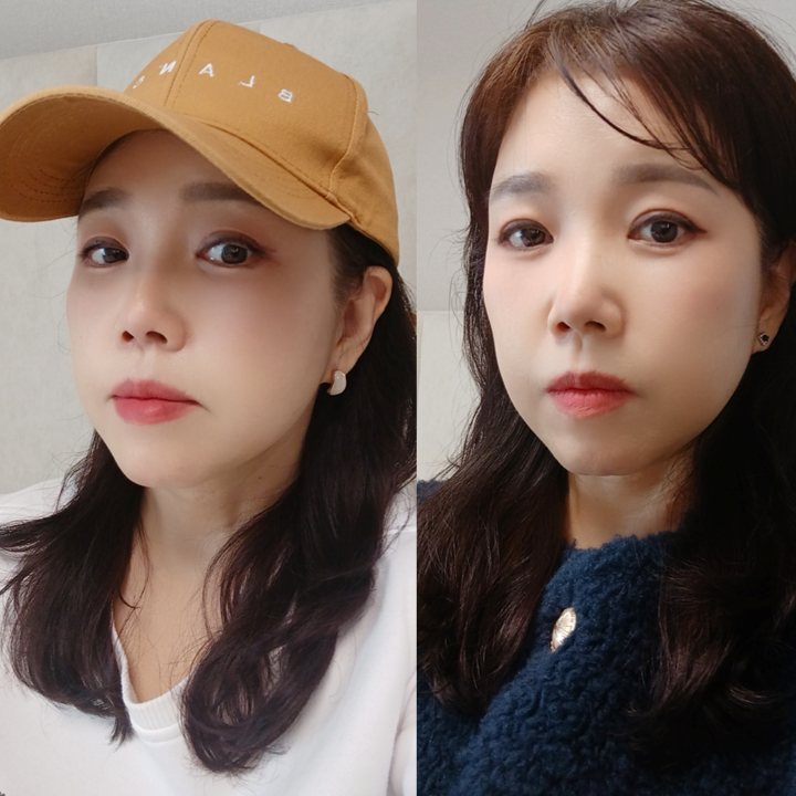 중년종합성형 상담과 수술의 범위 관련 이미지 9
