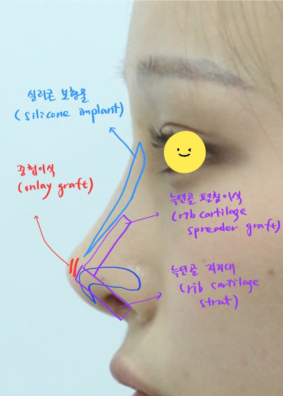 Rib Cartilage Rhinoplasty for a Deviated Saddle Nose image 10