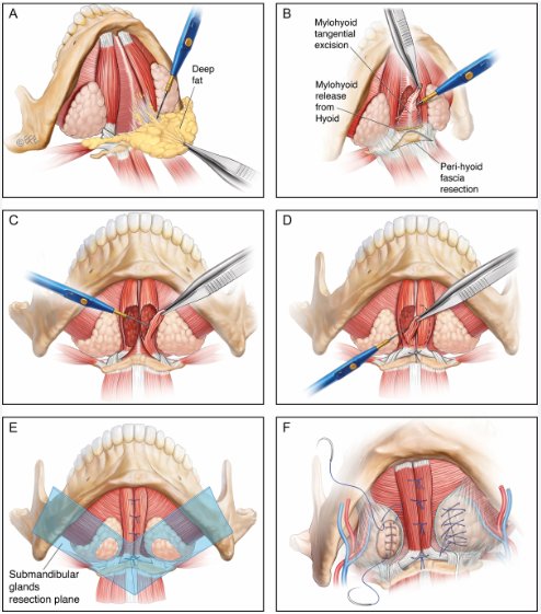 The Evolution of Double-Chin Surgery: From Liposuction to Pelican Surgery image 4