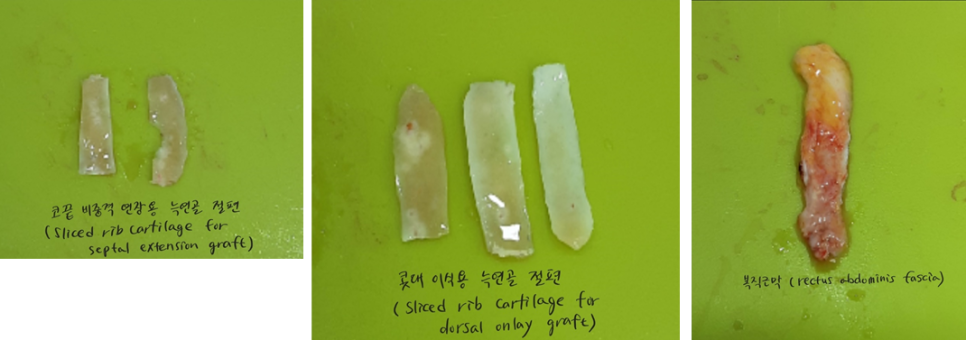 콧대에 실리콘 보형물을 늑연골로 대체하는 경우 관련 이미지 4