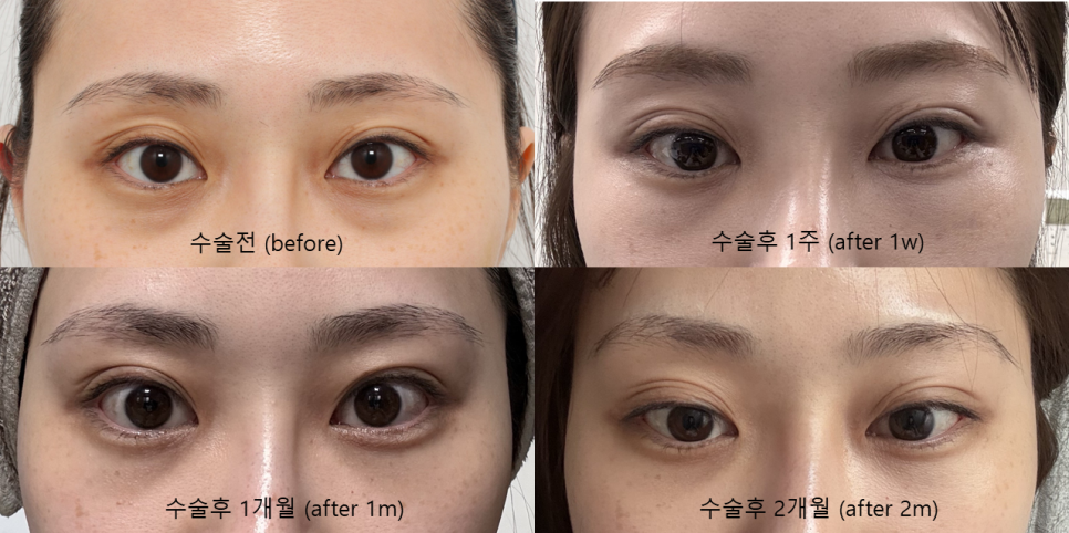 눈밑지방재배치, 복시&middot;사시는 걱정해야 할까요? (드문 부작용과 회복 과정) 관련 이미지 3
