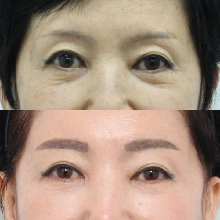 눈밑 수술을 하지 않았는데, 눈밑이 좋아졌습니다 관련 이미지 5