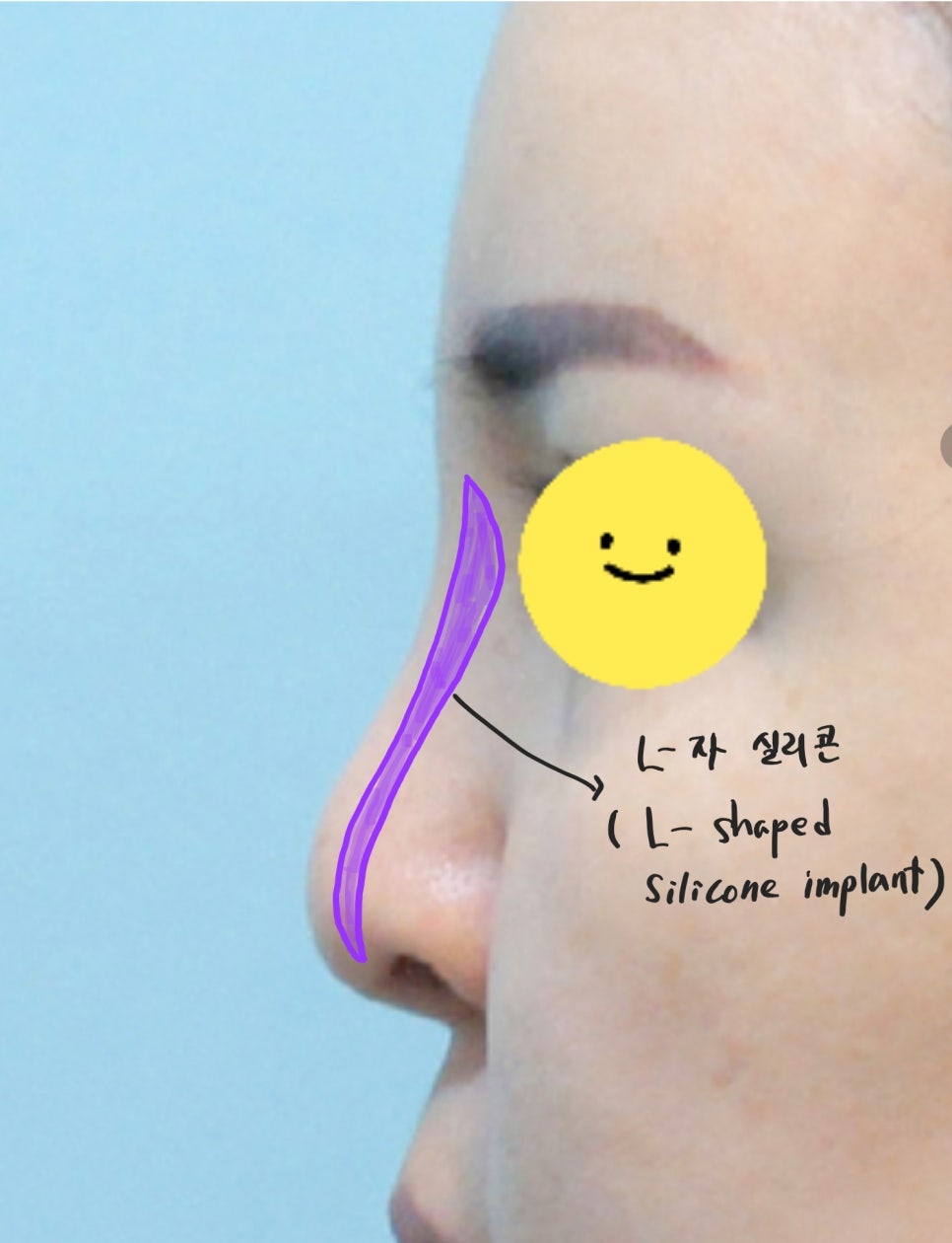 트렌드 변화에 따른 중년코 재수술 관련 이미지 1