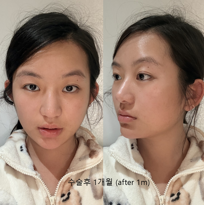 얼굴의 황금비율을 완성하는 이마축소술 관련 이미지 5