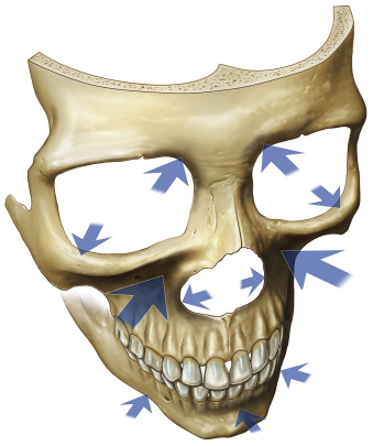 Does a Smaller Facial Skeleton Sag Faster? A Deep Mini Facelift Case in a Patient in Her 40s image 1