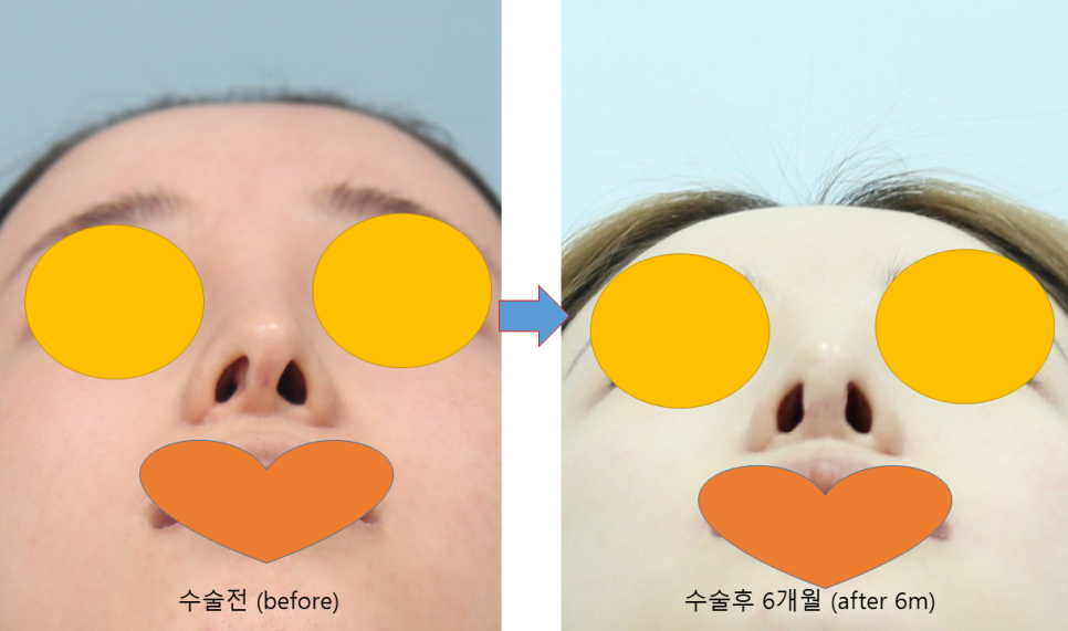 Consultation Process and Surgical Items for Revision Rhinoplasty image 8