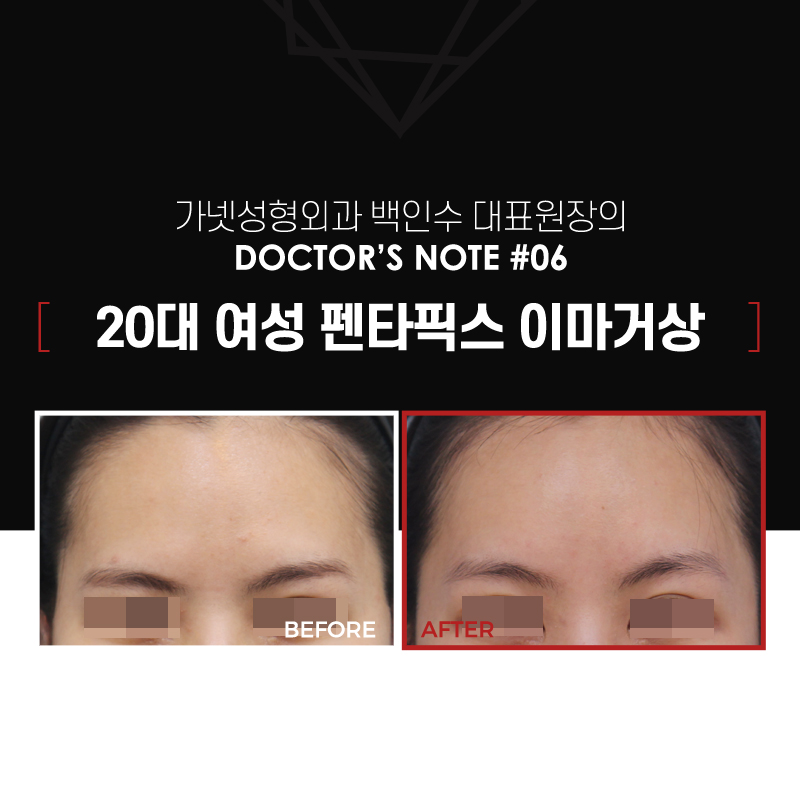 【Garnet Plastic Surgery Director Baek In-soo’s Plastic Surgery Column】 Improving Brow Ptosis with a Pentafix Forehead Lift in One’s 20s image 2