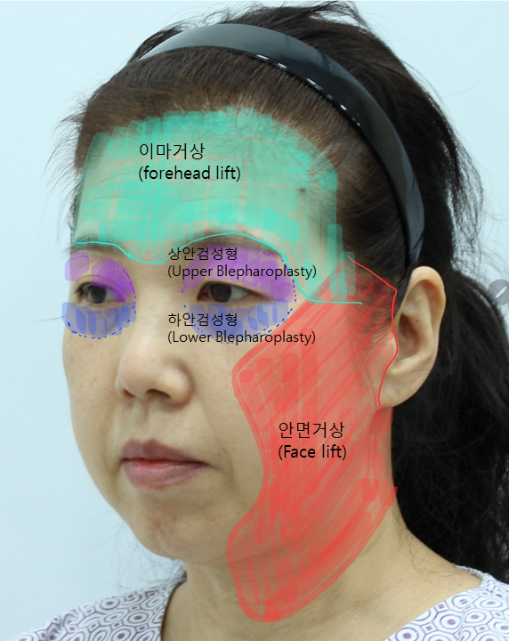중년종합성형 상담과 수술의 범위 관련 이미지 3