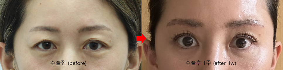 Recovery Process After a Subbrow Lift (Under-Brow Lift) image 3
