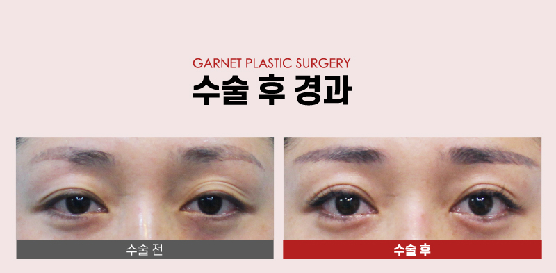 【가넷성형외과 백인수원장 성형칼럼】 쌍꺼풀재수술 (겹주름제거와 눈매교정술) 케이스 관련 이미지 7