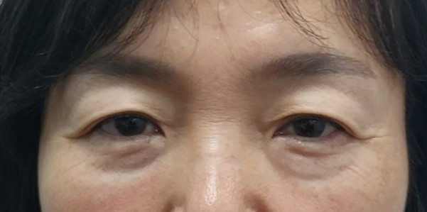 Why Horizontal Nasal Bridge Wrinkles and Eyelid Ptosis Occur Together, and the Role of Brow Lift Surgery image 1