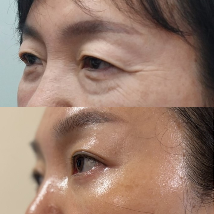 Why Horizontal Nasal Bridge Wrinkles and Eyelid Ptosis Occur Together, and the Role of Brow Lift Surgery image 8