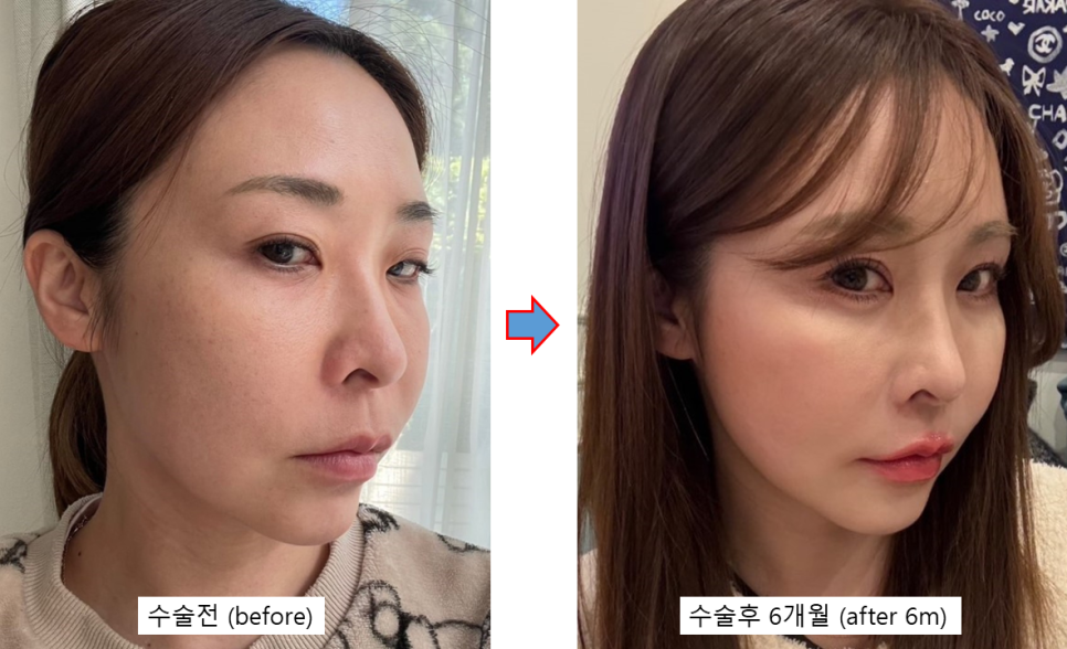 동안과 여성스러움을 동시에, 자연스러운 변화를 만드는 지방이식 관련 이미지 2