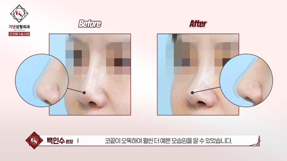 Why You Should Have Revision Rhinoplasty at a Place That Specializes in Apgujeong Nose Revision Surgery (ft. Dr. Baek In-soo) image 4