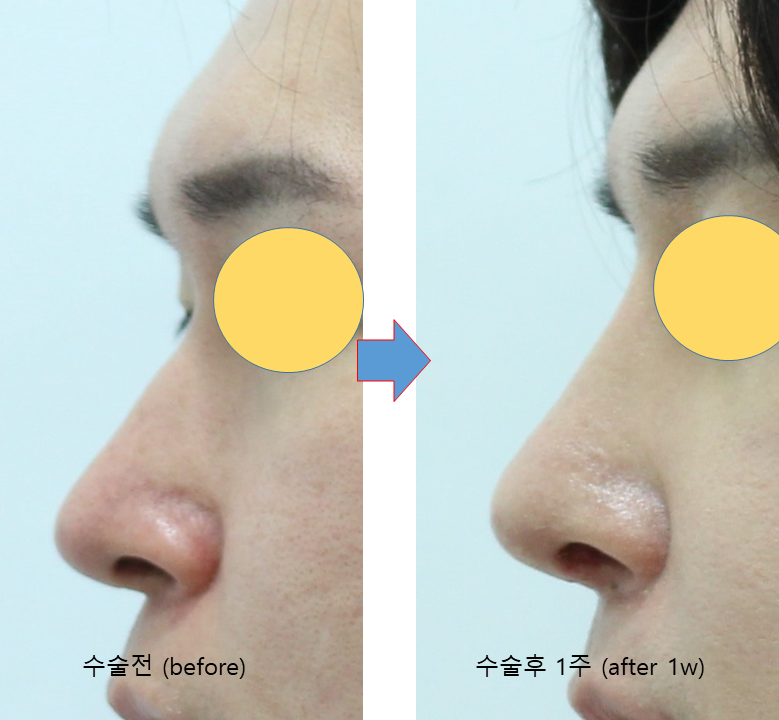 Male Rhinoplasty Performed Alongside Septoplasty image 7