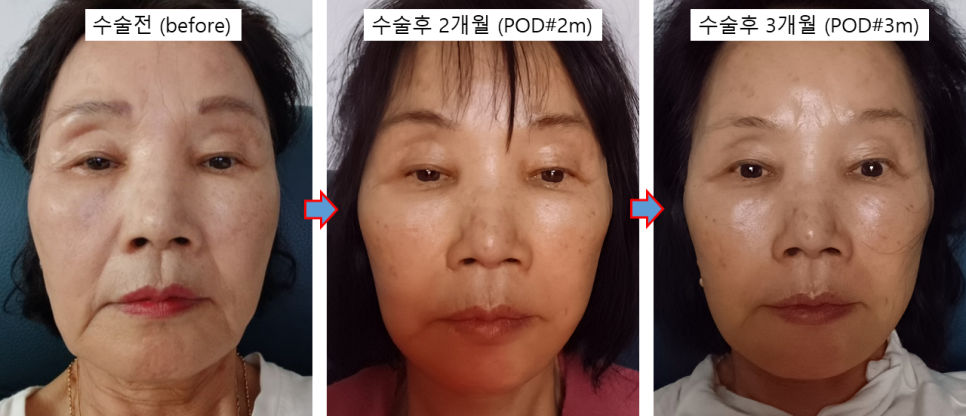 70대 안면거상 가능할까? 회복과정과 3개월 전후 실제 사례 관련 이미지 4