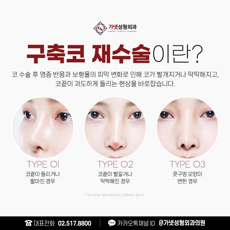 구축코재수술, 더 이상의 부작용을 피하고 싶다면? 관련 이미지 3