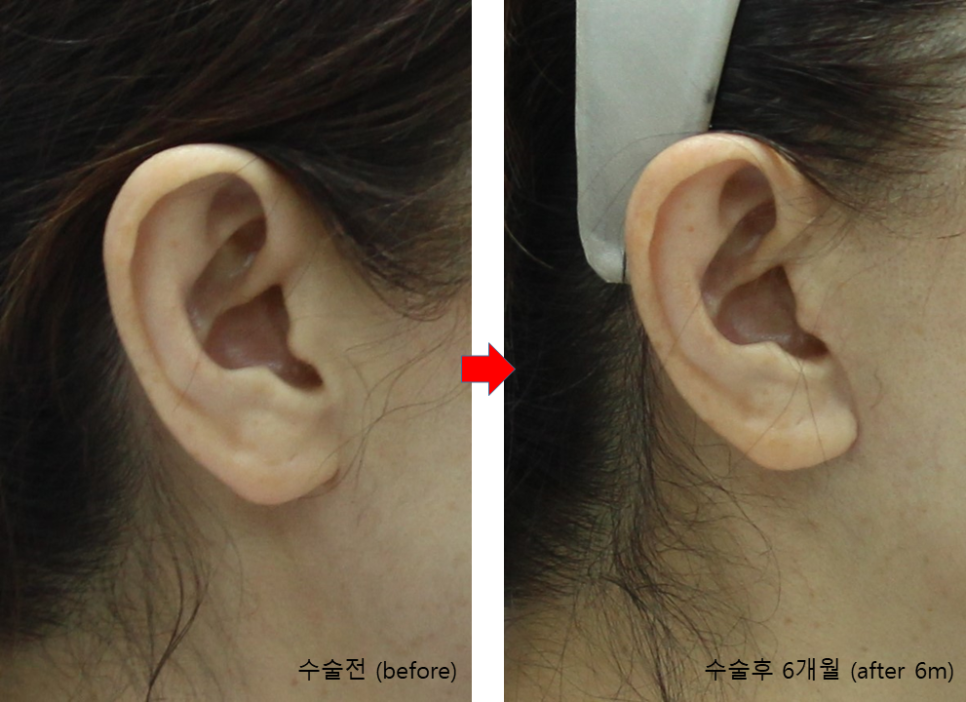안면거상후 흉터 성숙과정 관련 이미지 6