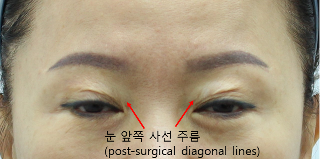 쌍꺼풀 재수술 흉터, 피부결을 따라야 자연스럽습니다 관련 이미지 2