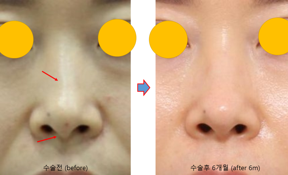 무보형물 코성형, 휜코까지 교정할 수 있을까? 관련 이미지 3
