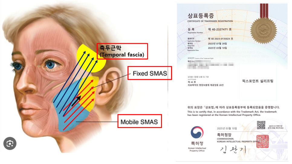 실리프팅, 어떤 실을 어떻게 사용하느냐가 중요한 이유 관련 이미지 2
