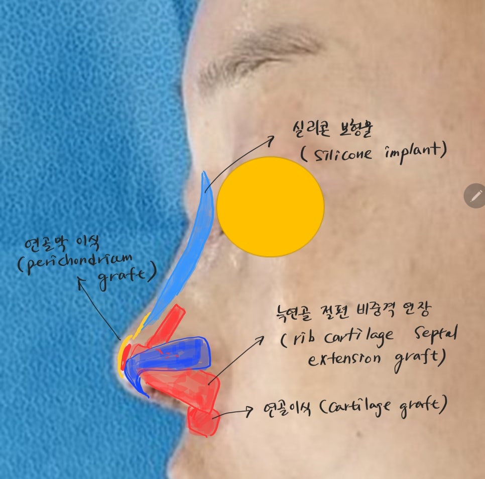 Use of Rib Cartilage in Midlife Rhinoplasty image 7