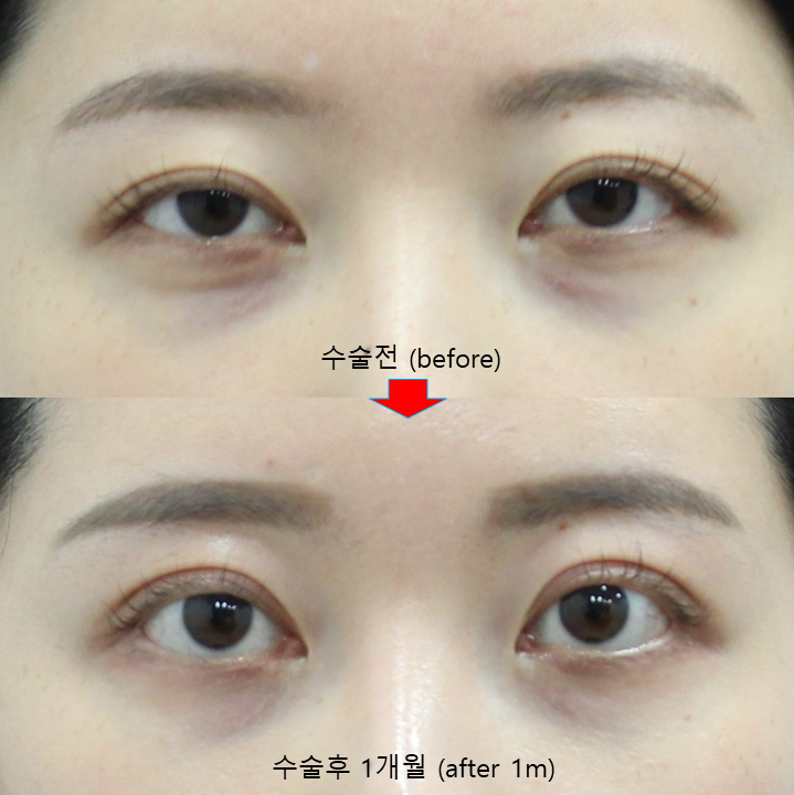 Non-incisional Eye Correction in Revision Surgery for Buried-Method Double Eyelids image 9