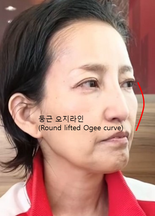 중안면의 볼륨감과 오지라인(Ogee curve) 관련 이미지 4