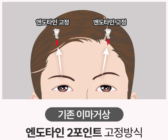 콧등 가로주름과 이마거상에서 중요한 고정포인트 관련 이미지 3