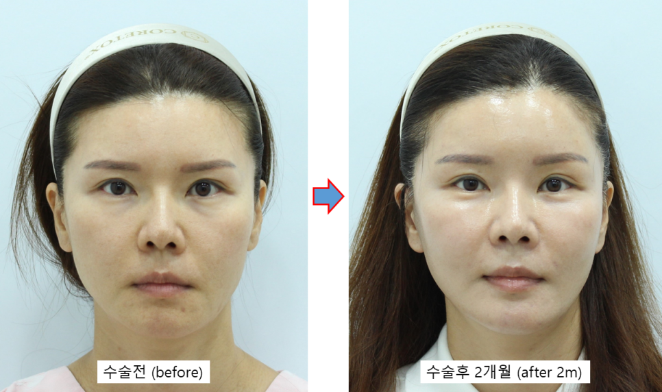 40대 후반 눈밑성형, 꼭 하안검일까? 눈밑지방재배치로 해결한 이유 관련 이미지 3