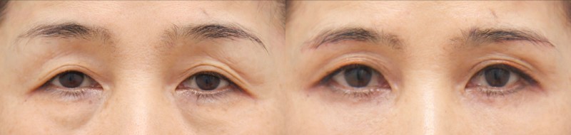 Choosing a Surgical Method for Upper Eyelid Skin Sagging image 7