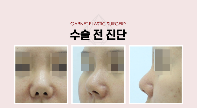 【Garnet Plastic Surgery Director Baek Insoo’s Plastic Surgery Column】 Rib Cartilage Contracted Nose Revision Surgery (Removal of Nose Implant) image 3