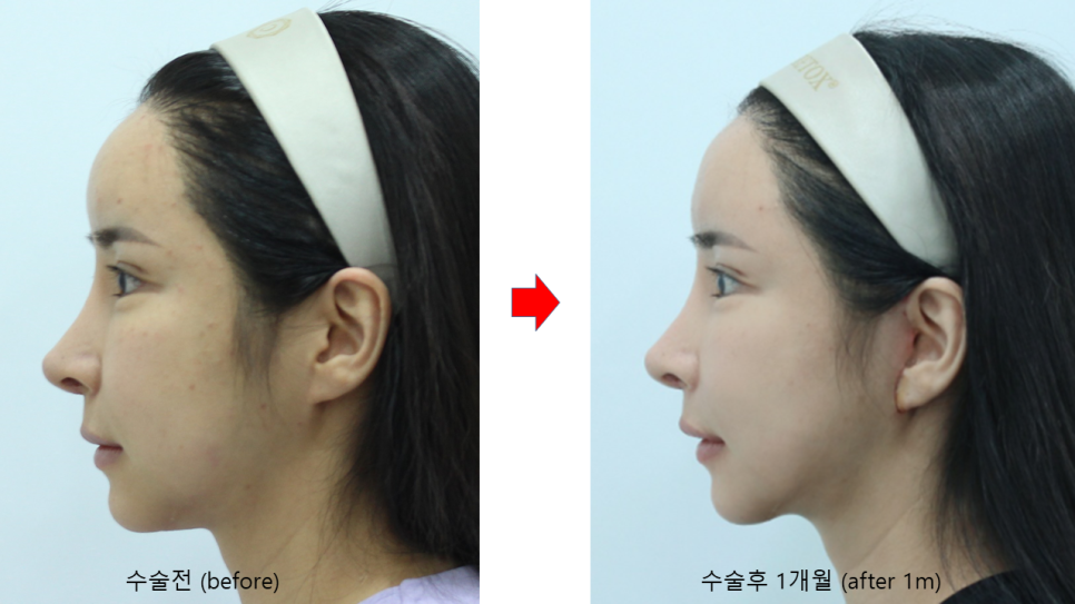 Sagging Skin After Facial Contouring Surgery (Cheek Sagging) image 10