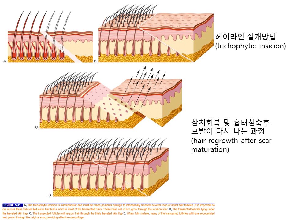 Forehead Reduction Surgery to Naturally Lower the Hairline image 3