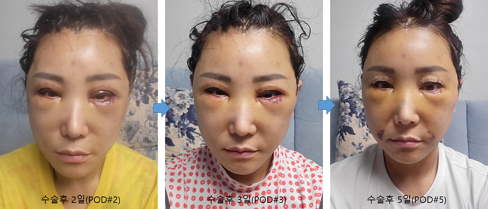 Hyperbaric Oxygen Therapy for Faster Recovery After Plastic Surgery image 4