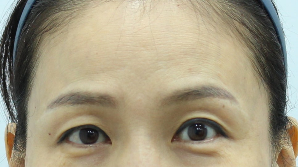 Forehead Lift to Correct Eyebrow Asymmetry image 1