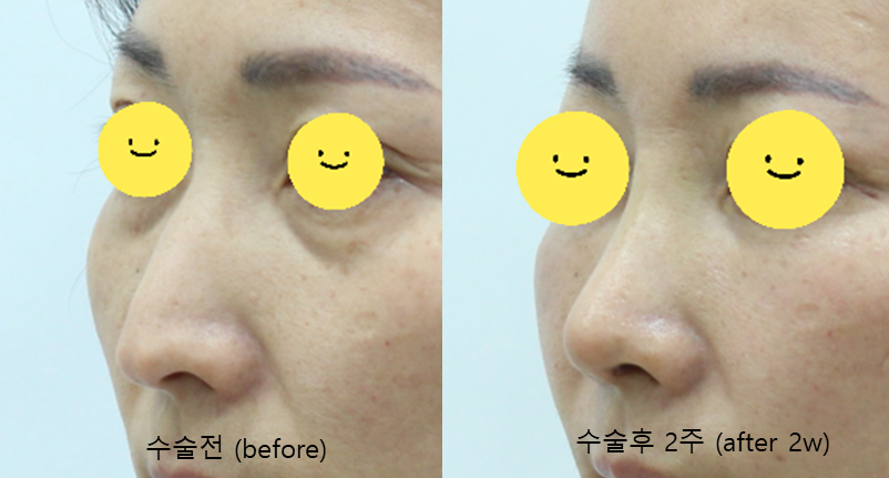 The Aging Process of the Nose and Midlife Rhinoplasty image 8