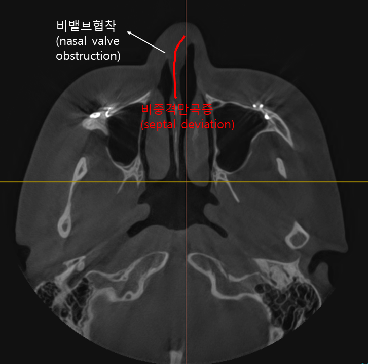 Consultation Process and Surgical Items for Revision Rhinoplasty image 2