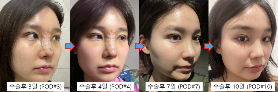 Will Rhinoplasty Cause Inflammation If You Have It in the Summer? Here’s a Real Recovery Case image 2