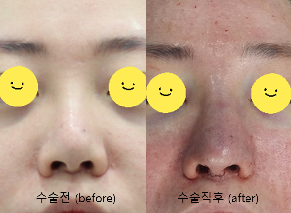 늑연골을 이용한 비주함몰의 교정 관련 이미지 9