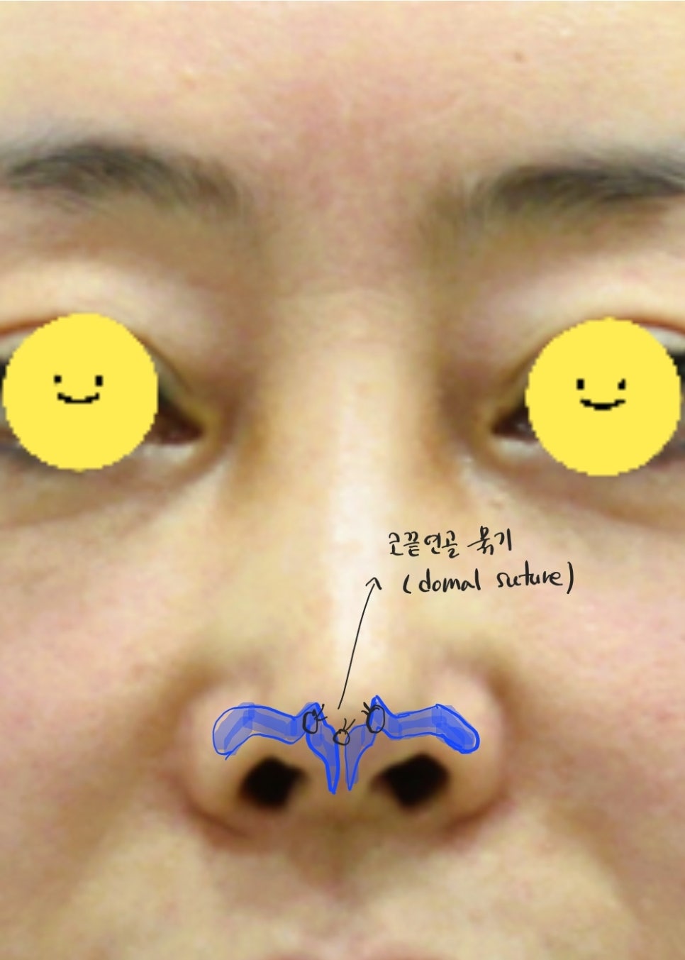 Correction of a Pinched Nose or Indented Nose image 4