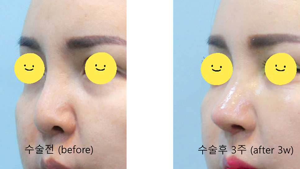 트렌드 변화에 따른 중년코 재수술 관련 이미지 7
