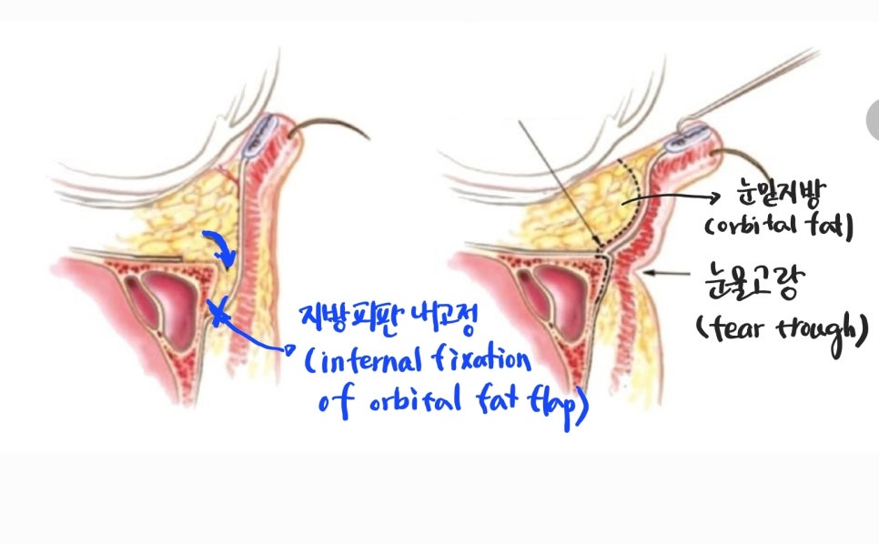 The Surgical Process of Lower Eyelid Fat Repositioning image 5
